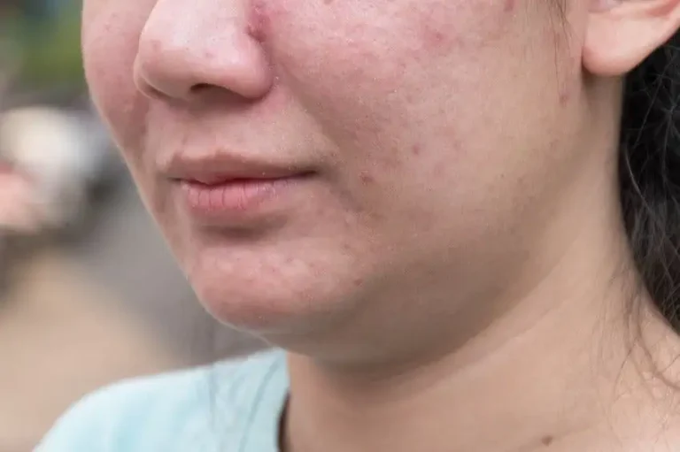Totarol and Licochalcone A: Fixing Breakouts Without Wrecking the Skin Barrier